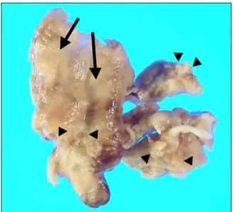 Figure  5.  Gross  findings  of  abnormal  tissue  resected  by  surgery  (size  4×2.5×2  cm)  showing  irregularly  shaped  lesions  (vegetation)  (arrow  head)  attached  to  relatively  smooth  surfaced  portion  (diseased  valve)  (arrow).