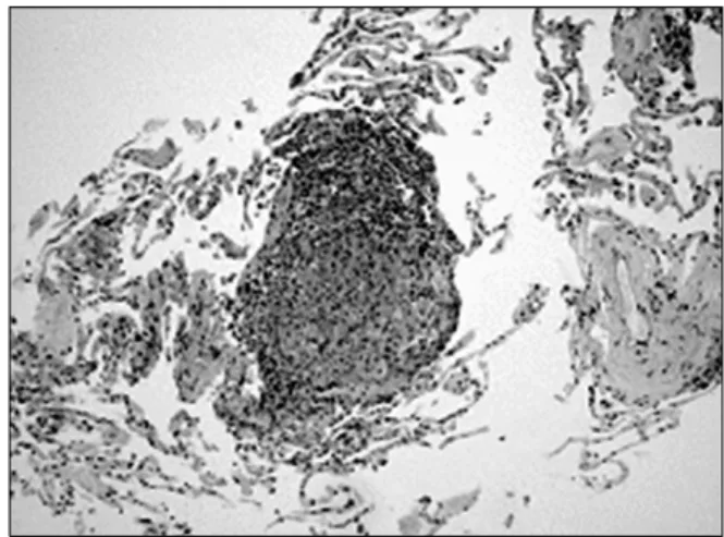 Figure  3.  PET-CT  scan  reveals  multiple  increased  FDG  uptake in bilateral mediastinal, hilar, and portocaval nodal station  (maximum  SUV:  5.06).