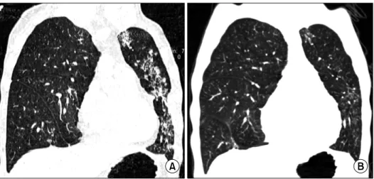Figure  3.  Coronal  section  of  lung  setting  shows  (A)  patchy  and  centrilobular  infiltration  in  line  along  anterior  chest  wall of  left  lung  field,  and  (B)  much  cleared  lung  field  after  antituberculosis  treatment  for  9  months.