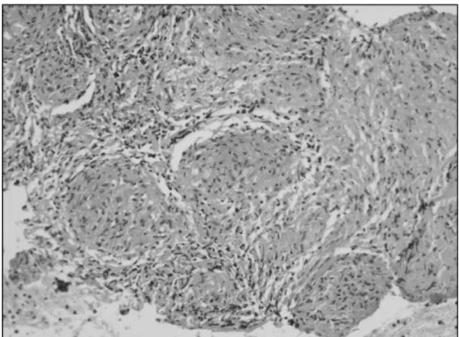 Figure  1.  Epithelial  non-caseating  granuloma  consistent  with  sarcoidosis  (H&amp;E  stain,  ×200).