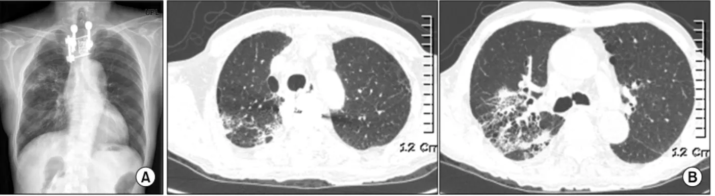Figure 1. (A) Chest radiography shows interstitial pneumonia in right upper lobe at the presentation