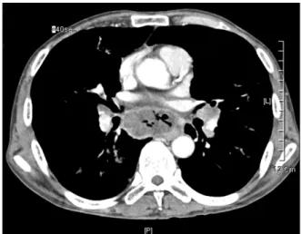 Figure 1. Chest X-ray on admission showed multiple con- con-solidations in right upper lung zone and left lingular lobe.