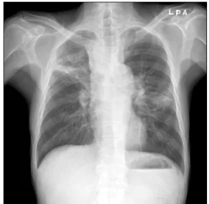 Figure  3.  Chest  CT  scan  during  follow  up  periods  re- re-vealed that the size of lymph node at subcarinal area was decreased  but  another  lymph  nodes  showed  variable 