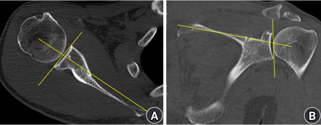 Fig. 1.  Two-dimensional measurement of glenoid version and inclination. (A) Glenoid version