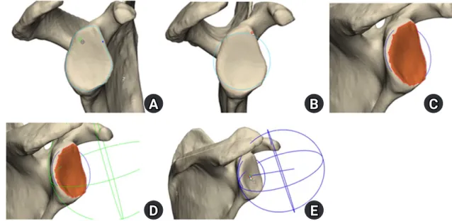 Fig. 2.  Making best-fit circle and sphere, and finding out the center of glenoid fossa