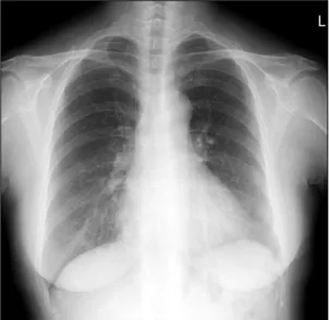 Figure  3.  There  is  marked  improvement  of  the  previous  lesion  on  chest  radiograph  two  months  later.