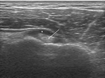 Fig. 2.  Sonographic finding of the partial-thickness rotator cuff tear.  The arrow indicates the partial-thickness rotator cuff tear.