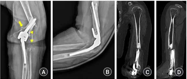 Fig. 1.  Elbow anteroposterior (A) and lateral (B) radiographs, coronal (C) and sagittal (D) view of computed tomography images of total elbow  arthroplasty with periprosthetic fracture