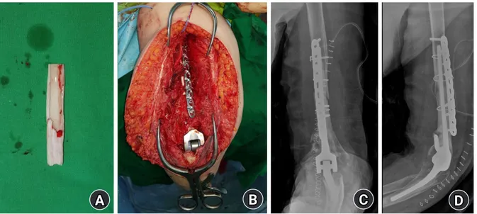 Fig. 2.  Allograft fibula strut bone that was manipulated with a high-speed burr (A), and clinical photograph of the operative field after fixation  with a locking plate and cerclage wire (B)