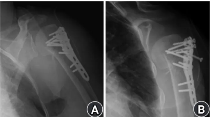 Fig. 2.  Open reduction internal fixation with locking plate and  screws. (A) Postoperative anteroposterior (AP) X-ray showed  re-duced state