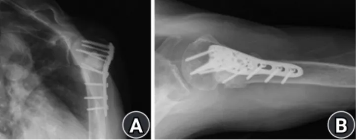 Fig. 4.  Healing of fracture without screw back-out or loss of reduc- reduc-tion 6 months later