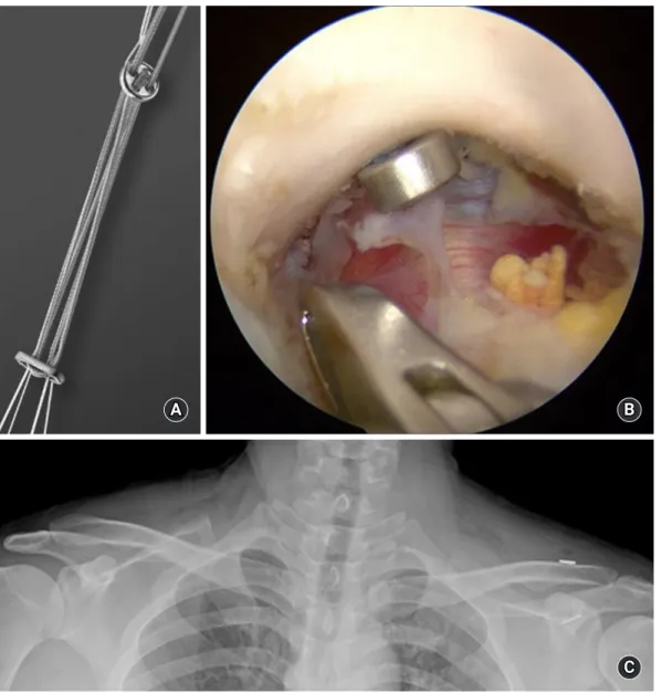 Fig. 2. Arthroscopic-assisted procedures with a coracoclavicular (CC) suspension device