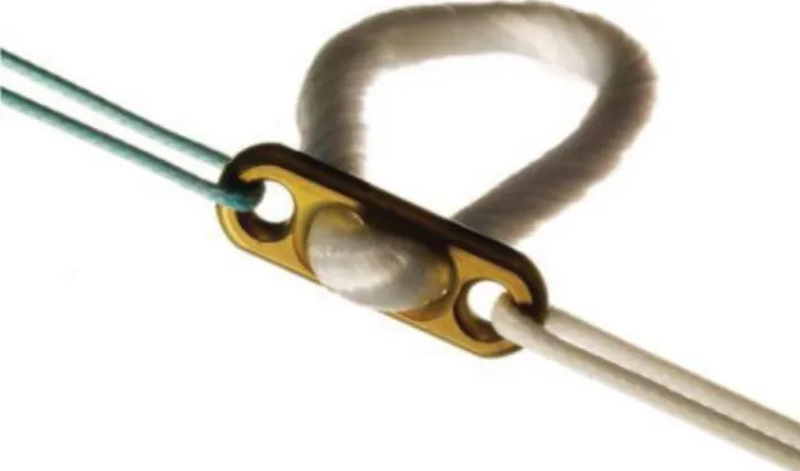 Fig. 4. A coracoclavicular (CC) suspension device: (A) the Dog-Bone device, (B) illustration of CC fixation using a Dog Bone device.Fig