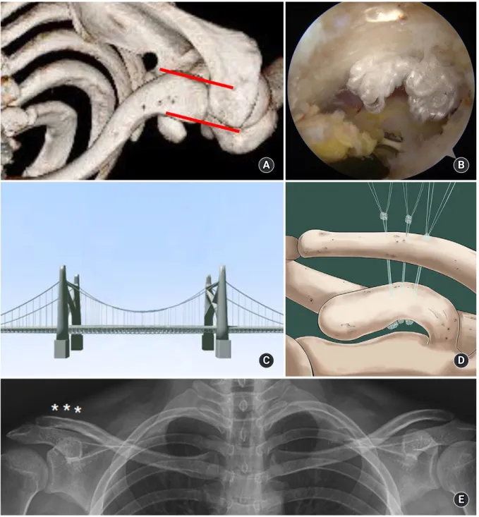 Fig. 5. (A) A computed tomography image after three-dimensional reconstruction shows correction of horizontal instability of the left clavicle