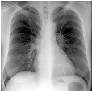Figure 1. Initial Chest PA showed slightly increased retic- retic-ular  pattern  in  both  lower  lobes.