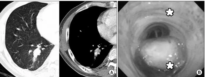 Figure  1.  Endobronchial  metastasis  from  renal  cell  carcinoma  in  a  59-year-old  man  with  non-massive  hemoptysis