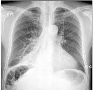 Figure 1. Chest PA showed dense consolidation blurring the  right  cardiac  border  of  the  right  lower  lung  field.