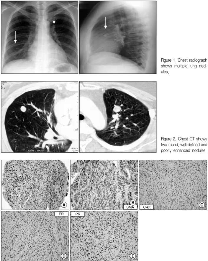 Figure 1. Chest radiograph shows  multiple  lung   nod-ules.