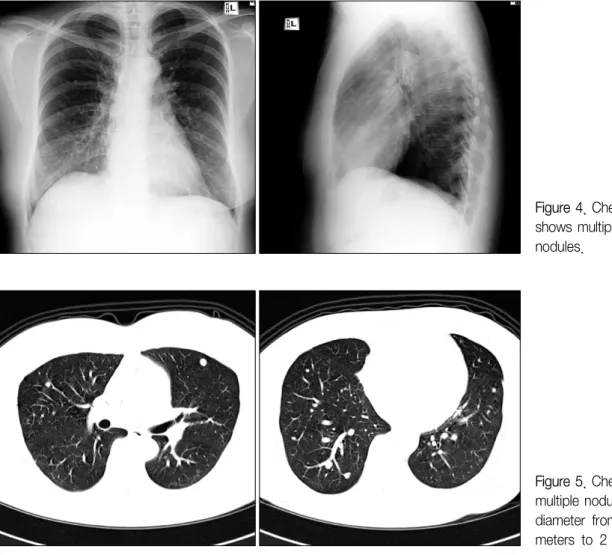 Figure 4. Chest radiograph shows multiple, round lung nodules.