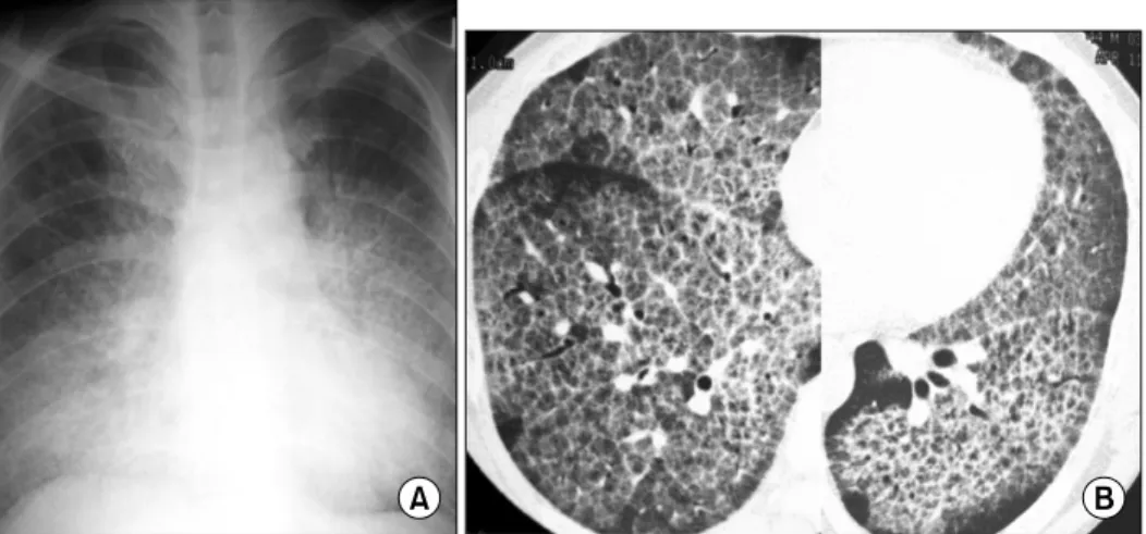 Figure  1.  Initial  pre-whole  lung  lavage  chest  radiograph  and  high-resolution  computed  tomography  (HRCT)  findings