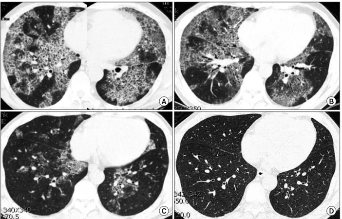 Figure 3. Serial follow up high-resolution computed tomography (HRCT) findings. Pre GM-CSF treatment baseline HRCT scan shows diffuse extent of “crazy paving” pattern (A)