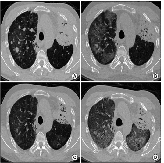 Figure  1.  Low  dose  chest  computed tomography (CT) before  (A)  and after  (B)  the  first  interstitial  lung  disease  (ILD)  episode