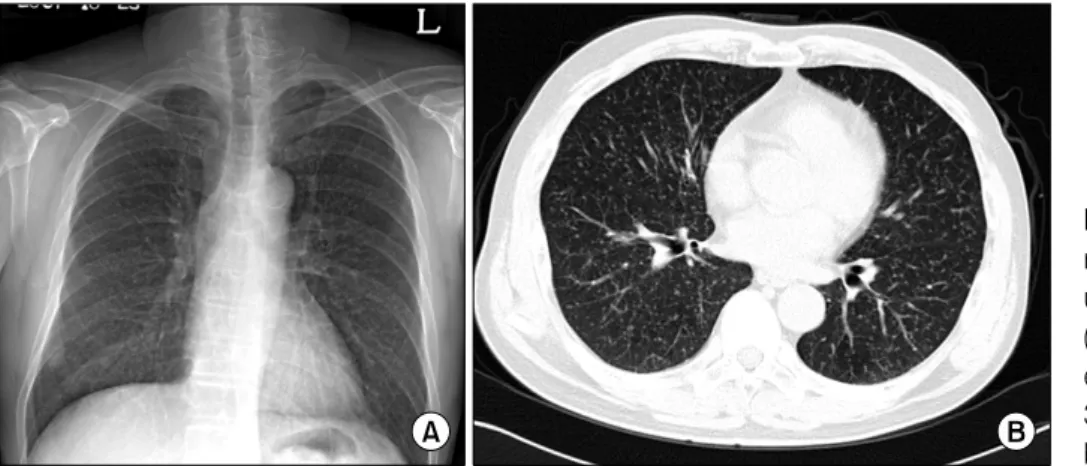 Figure 2. Lung tissue shows granuloma and central case- case-ous  necrosis  (H&amp;E  stain,  ×100).