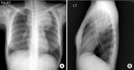 Figure 1. Chest X-ray sug- sug-gests huge mass lesion on left upper lung fileds (A, B).
