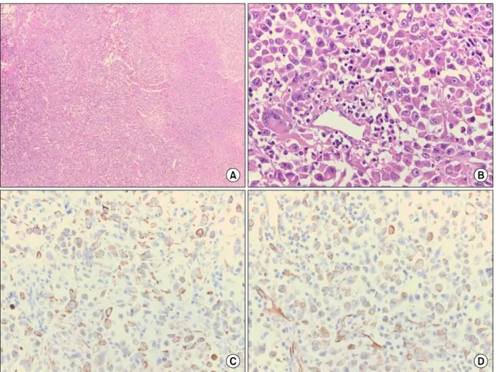 Figure  4.  Histopathologic  findings  shows  round  tumor  cells  infiltrating  surrounding  tissues  with  eosinophilic  cytoplasm  containing amorphous inclusion body (H&amp;E stain; A, ×40, B, ×400), positive staining in cytoplasm (Immunohistochemical 