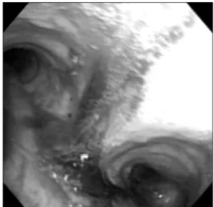 Figure 2. Computed tomography image with a lung win- win-dow setting shows clustered small and large cavitary  le-sions with wall thickening in left lower lobe, predominantly superior  segment.