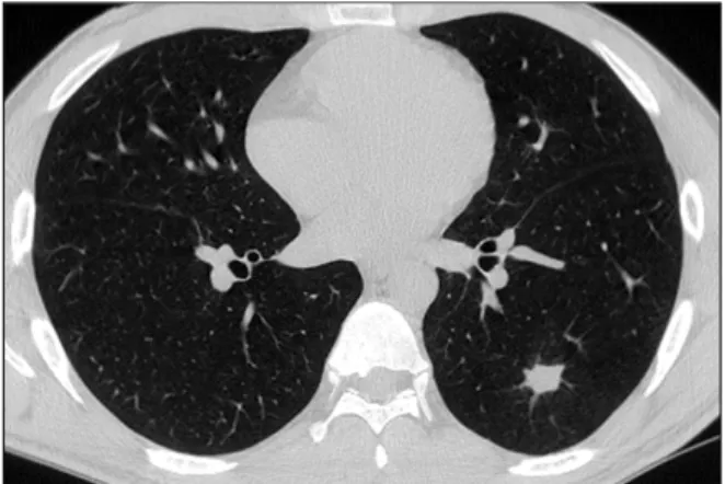 Figure  5.  Follow  up  chest  computed  tomography  per- per-formed 4 months later shows much regression of the  pre-viously  noted  cavitary  and  infiltrative  lesion.