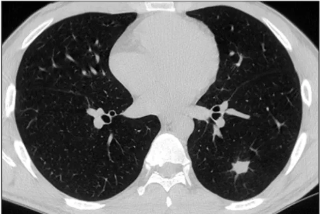 Figure  5.  Follow  up  chest  computed  tomography  per- per-formed 4 months later shows much regression of the  pre-viously  noted  cavitary  and  infiltrative  lesion.