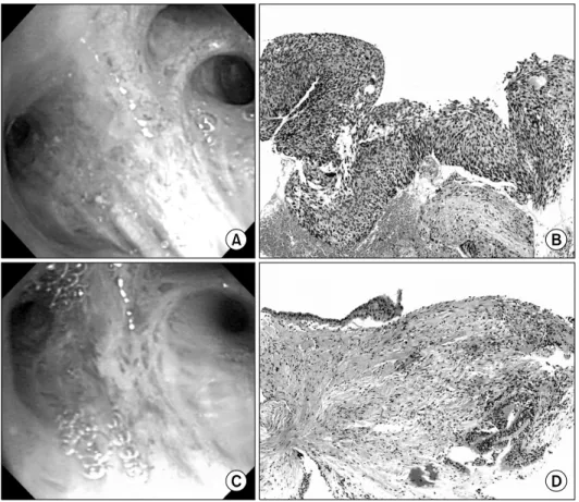 Figure 1. Patient 1, with superficial  squamous cell  carcinoma at  the right upper  lobe