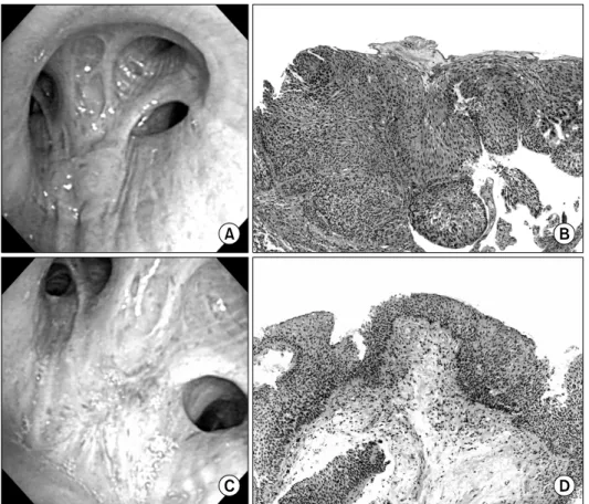 Figure 2. Patient 2, with superficial  squamous cell  carcinoma at  the right upper  lobe