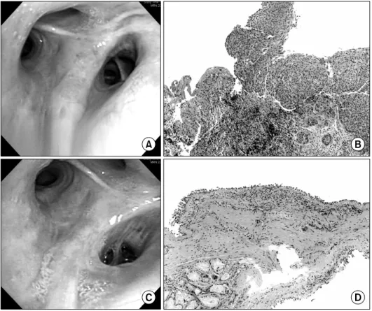Figure  3.  Patient  3,  with  superficial  squamous  cell  carcinoma  at  the  right  upper  lobe