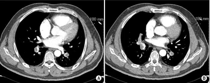 Figure  1.  Chest  CT  scan  shows  multiple  low  densities  in  both  pulmonary  arteries  (A),  and  in  lobar  arteries  (B).증      례    환 자:  45세,  남자    주 소:  호흡곤란    현병력: 내원 하루 전 우측 다리의 통증이 생겼고 내원 직전 호흡곤란이 발생하여 내원하였다