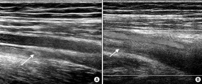 Figure  2.  Doppler  ultrasonogram  shows  echogenic  lesion  (arrow)  in  Rt.  femoral  vein  (A)  and  no  blood  flow  in  same  lesion  (B)
