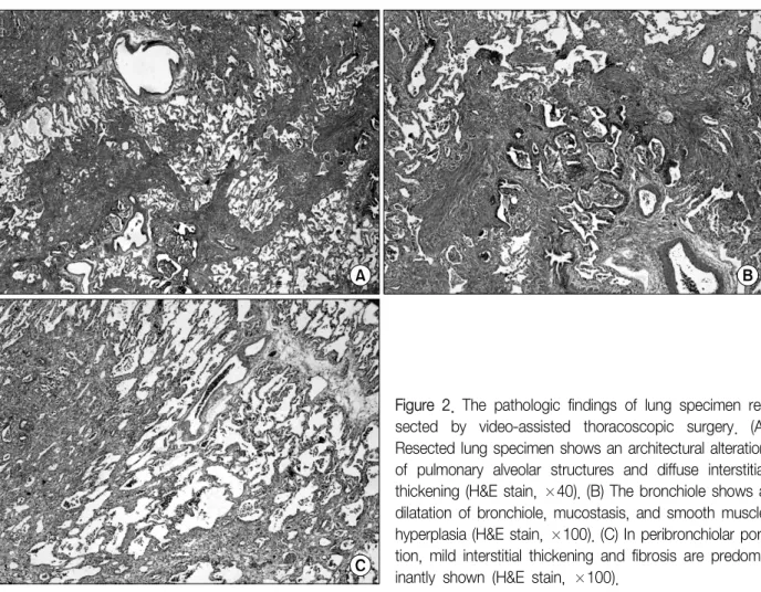 Figure  2.  The  pathologic  findings  of  lung  specimen  re- re-sected  by  video-assisted  thoracoscopic  surgery
