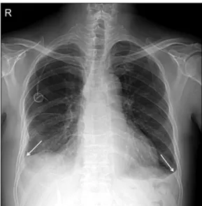 Figure  3.  Follow  up  chest  radiograph  after  19  months  shows regression of large neck mass and bilateral pleural effusions  (arrows).