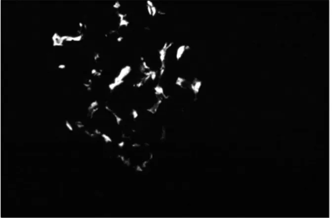 Figure 4. Mild mesangial Ig A deposits in the mesangium of  glomeruli.  (IF  ×400).