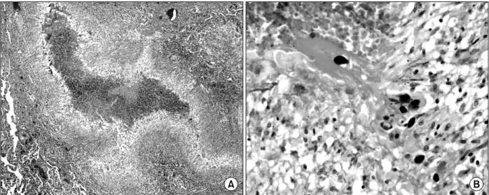 Figure 1. Initial chest CT scan shows about 1 cm sized two lobulated consolidative lesions with peripheral ground glass opacity  and  halo  on  right  middle  lobe  that  is  adjacent  to  mediastium  (A,  B)