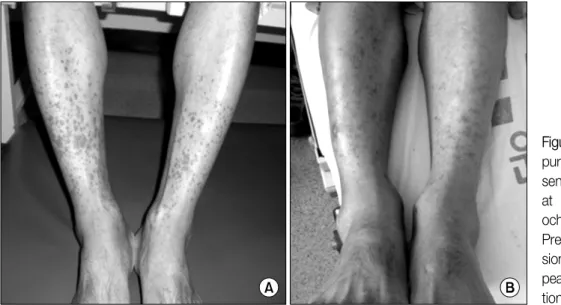 Figure  2.  (A)  Multiple  pur- pur-puric  skin  lesions  are   pre-sented  on  both  lower  legs  at  the  diagnosis  of   Hen-och-Schönlein  purpura