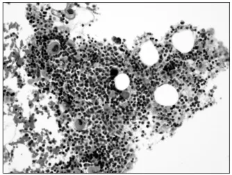 Figure  4.  Peripheral  blood  smear  findings.  The  platelet  number  was  markedly  decreased  (Wright-Giemsa  stain,