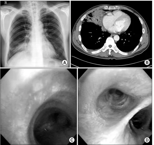 Figure  1.  (A)  Chest  X-ray  shows consolidation on  rig-ht  lower  lung  field  at   ad-mission
