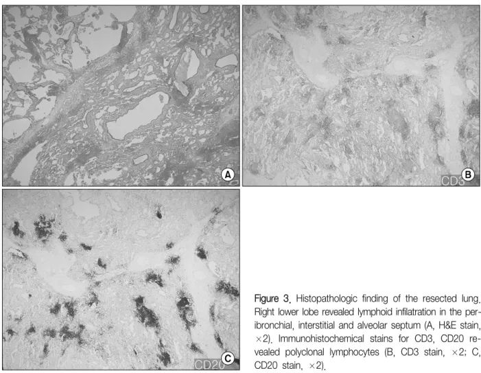 Figure  3.  Histopathologic  finding  of  the  resected  lung. 