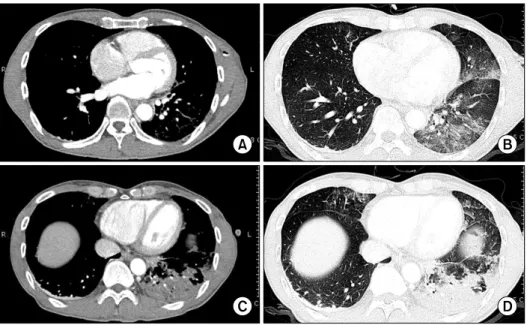 Figure  3.  Computerd  tomography  were  checked  immediately  after  detection  of  consolidation  by  chest  radiography