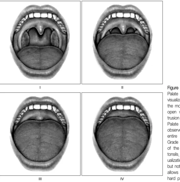 Figure  1.  The  Friedman  Palate Position is based on visualization of structures in the  mouth  with  the  mouth  open  widely  without   pro-trusion  of  the  tongue 26 