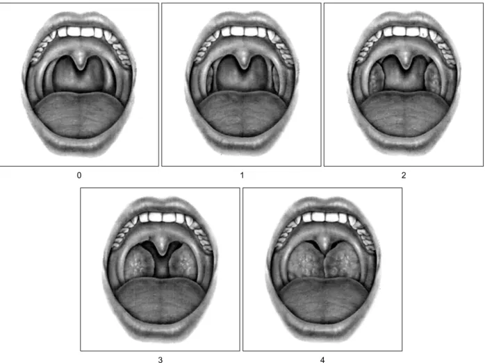 Figure  2.  Tonsil  size  is  graded  from  0  to  4 26 .  Tonsil  size  0  denotes  surgically  removed  tonsils