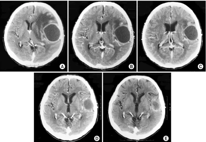 Figure  4.  Contrast-enhanced  brain  computed  tomography  (CT)  scanning  of  patient