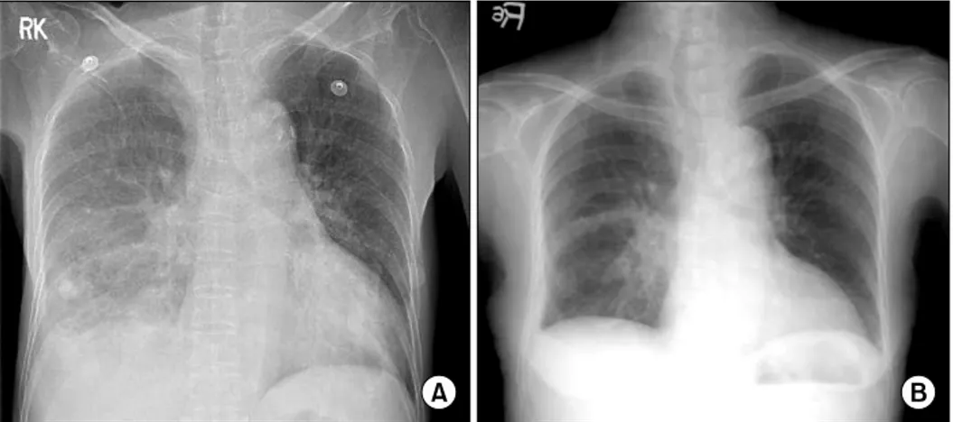 Figure  2.  Chest  CT  on  admission  Large  multiloculated  pleural  empyema  with  numerous  air  bubble  is  shown  in  right  pleural  space.
